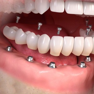 Zahnersatz auf Zahnimplantaten | Quelle: Initiative proDente