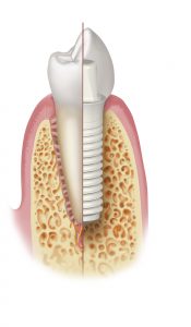 Zahnimplantate aus Keramik | Zahnarzt Nürnberg