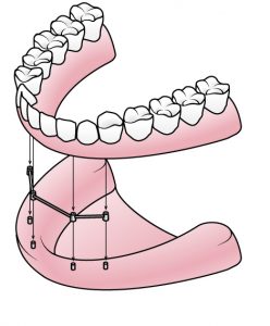 Zahnimplantate: Versorgung von zahnlosen Kiefern | Zahnarzt Nürnberg