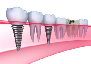 3D-Planung für passgenau Zahnimplantate | Zahnarzt Nürnberg