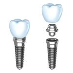 Navigierte Implantologie: Präzises Setzen der Zahnimplantate | Zahnarzt Nürnberg
