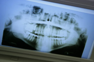 Knochenaufbau – Stabiles Fundament für Zahnimplantate | Zahnarzt Nürnberg